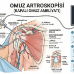 Omuz Ağrılarına Kapalı ve Kalıcı Çözüm: İleri Artroskopik Cerrahi Yaklaşımları